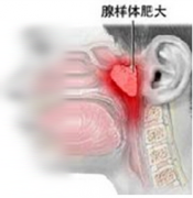腺样体肥大症状图