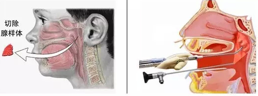 手术治疗腺样体肥大