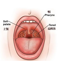 慢性咽炎