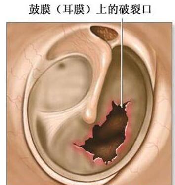 鼓膜上的破裂口