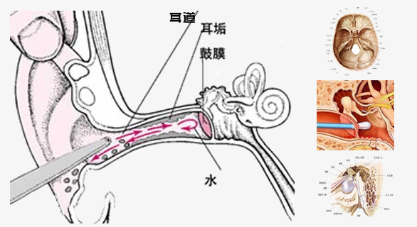 耳朵进水导致的鼓膜穿孔