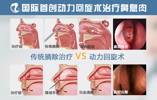 鼻息肉传统手术与动力回旋手术对比