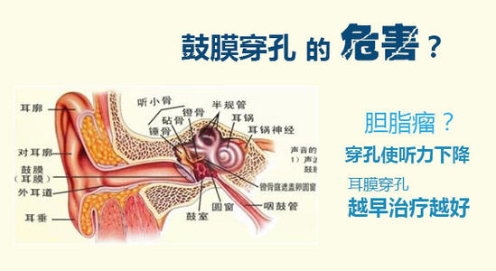 成都鼓膜穿孔的危害及治疗方法