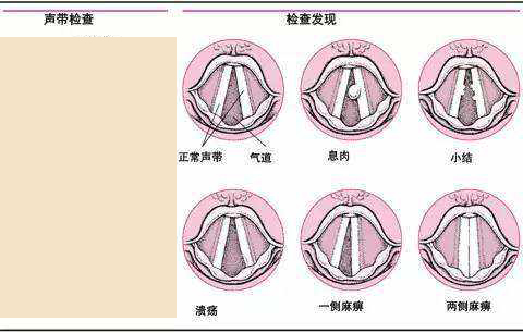 成都声带息肉怎么治疗才好