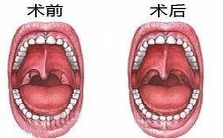得了扁桃体肥大该怎么治
