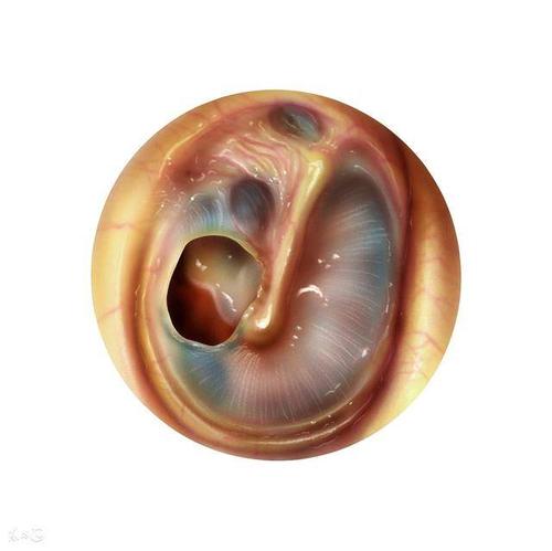 鼓膜穿孔会引起听力下降吗