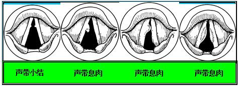 声带息肉的症状有哪些