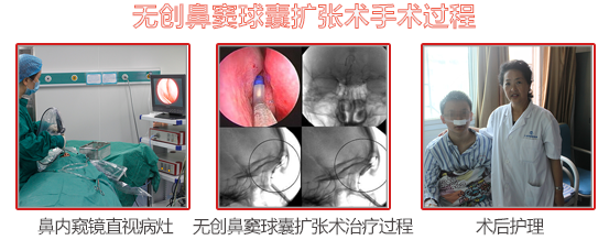 成都鼻窦炎对人们日常生活的影响有哪些